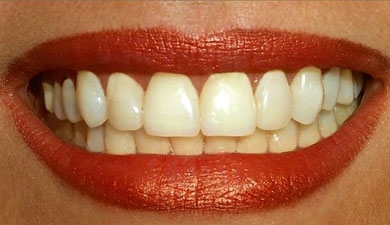 CONSEJOS DE SALUD ¿Qué amarillea realmente los dientes&#63;