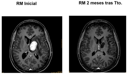 Valdecilla comienza con los tratamientos de radiocirugía en tumores y anormalidades funcionales cerebrales